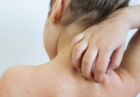 Pediatrdan SOS "Qızılcanın fəsadları illərlə bədəndə qalır"  