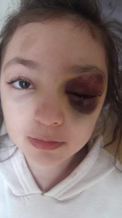 Müəllim adına NÖVBƏTİ LƏKƏ: Ramanadakı məktəbdə  azyaşlı qız uşağını tanınmaz hala kim salıb? - FOTOLAR