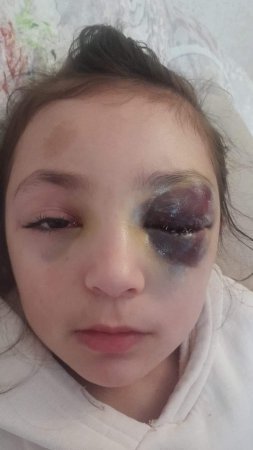 Müəllim adına NÖVBƏTİ LƏKƏ: Ramanadakı məktəbdə  azyaşlı qız uşağını tanınmaz hala kim salıb? - FOTOLAR